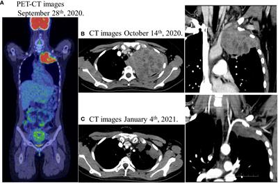 Case report: Pathological complete response of pregnancy associated pulmonary enteric adenocarcinoma to chemoradiotherapy